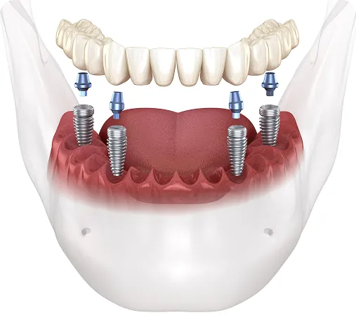 All On X dental implant system — exploded view of full-arch implants